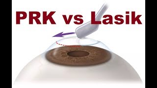 PRK VS Lasik Hindi [upl. by Nodnek]