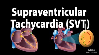 Supraventricular Tachycardia SVT PSVT Animation [upl. by Anauqcaj]