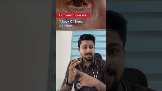 കൺപോള തുടിക്കൽ Kanpola Thudikkalmyokymia or eyelid twitchmalayalam kerala eyes eyelid health [upl. by Violeta]