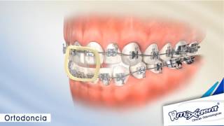 Corrección de mordida y espacios dentales quotOrtodonciaquot [upl. by Antebi556]