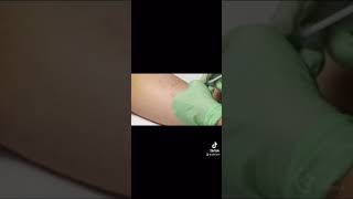 Removing birth control implant [upl. by Tremayne]