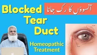 Tear Duct Blockage Homeopathic Medicine  Clogged Lacrimal Sac  Dacryocystitis Treatment [upl. by Anividul]