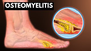 Osteomyelitis What You Need To know [upl. by Fregger96]