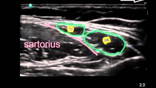 lateral femoral cutaneous nerve [upl. by Chew363]