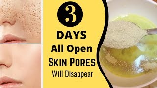 3 Days and All Open Pores Will Disappear from Your Skin Forever [upl. by Doomham]