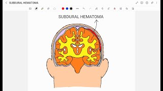 SUBDURAL HEMATOMA [upl. by Kennedy]