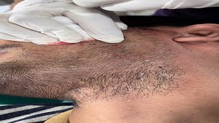 The Secret to Successful White Beard Permanent Removal AWISH Clinic whitebeard viral shorts [upl. by Noryv225]