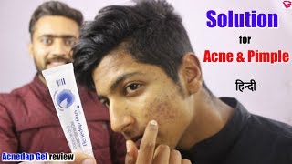 Best gel for Acne and Pimples  Effect Results How to use  Acnedap plus gel review [upl. by Issak]