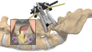 MAS® TLIF Patient Animation [upl. by Narruc]