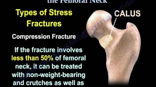 Stress Fractures Of The Femoral Neck  Everything You Need To Know  Dr Nabil Ebraheim [upl. by Arimaj]