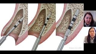 Posicionamento tridimensional de implantes em região estética como definir o perfil de emergência [upl. by Amimej601]