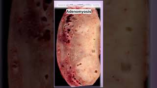 ADENOMYOSIS How It Affects Pregnancy endometriosistreatment [upl. by Woermer]