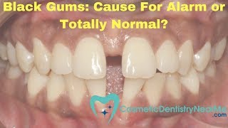 Black Gums Sign of a Problem or Completely Normal [upl. by Alli183]