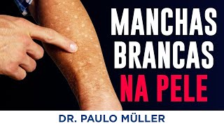 Leucodermia Solar – Manchinhas Brancas na Pele dos Braços e Pernas – Dr Paulo Muller Dermatologista [upl. by Euqinomad]