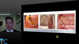 Medication related osteonecrosis of the Jaw by Dr Matt Koepke [upl. by Ecinom]