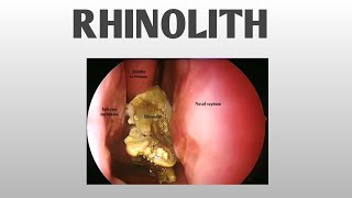 RHINOLITH  ENT [upl. by Bouchier506]