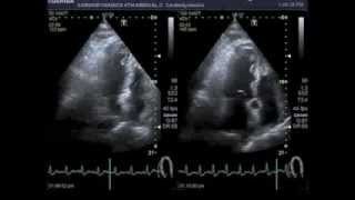 Bicycle stress echocardiography [upl. by Nnyw184]