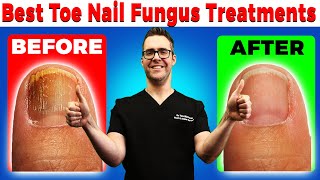 Best Toe Nail Fungus Treatments Onychomycosis Remedies [upl. by Ezzo]