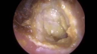 194 Eardrum about to EXPLODE after Blocked Ear Wax Removal using Endoscopic Ear Microsuction [upl. by Zeus608]