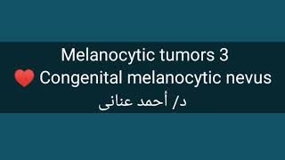 3 Congenital melanocytic nevus by Dr Ahmed Anany [upl. by Jepson664]