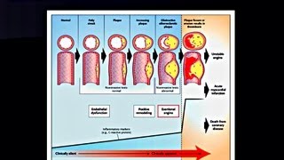 Chronic Stable Angina  Medical Presentation [upl. by Nolahs84]