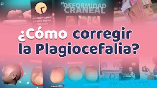 ¿Como corregir la plagiocefalia Plagiocefalia Argentina [upl. by Aehsrop897]