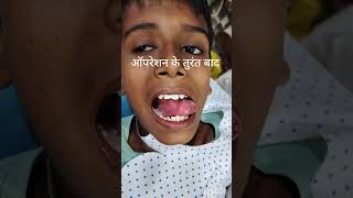 Ankyloglossia बच्चे की जीभ की सर्जरी। Tongue tie। DR Abhishek Mishra MDS Rewa [upl. by Giacinta484]