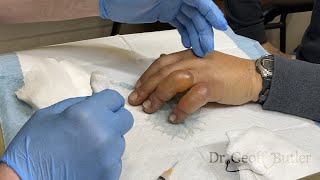 Drainage of blisters secondary to frostbite [upl. by Birkett516]