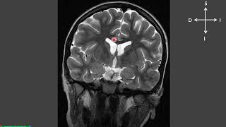 Resonancia Magnética del Encéfalo y el Sistema Ventricular [upl. by Andres]