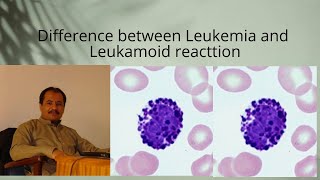 Difference between CML and leukemoid reaction Practical points [upl. by Ahselet]