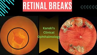 Retinal breaksKanskis clinical ophthalmology retinal tear retinal detachment subretinal fluid [upl. by Lieberman]