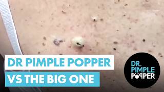 Dr Pimple Popper vs THE BIG ONE [upl. by O'Shee889]