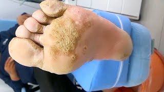 Remove severe massive plantar warts  Satisfying amp Relaxing Video38 [upl. by Oluas]