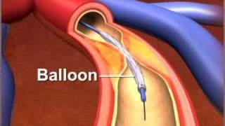 Percutaneous coronary Intervention stenting [upl. by Nywroc]