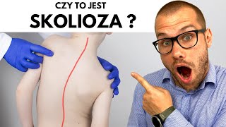 SKOLIOZA  wszystko co musisz wiedzieć [upl. by Weixel626]