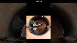 Achieving optimal centration of a MultiFocal IOL [upl. by Jocelyn]