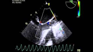 Cardiac arrest VENTRICULAR FIBRILLATION DURING TOE [upl. by Lipinski]