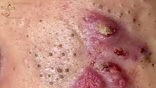 Blackheads Extraction Whiteheads Removal Pimple Popping 1 [upl. by Erlinna]