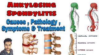 Ankylosing Spondylitis  Cause  Pathology  Symptoms  Treatment Nursing Lecture in Hindi MSN 1 [upl. by Rustice]