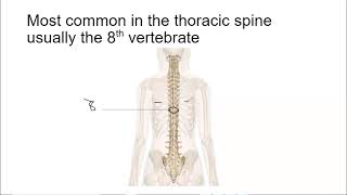 Hemivertebrae [upl. by Arerrac250]