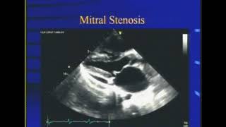 Mitral stenosis Dr S K Parashar [upl. by Debera88]