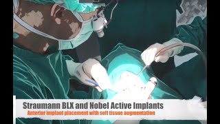 Straumann BLX and Nobel Active in the aesthetic zone with soft tissue augmentation [upl. by Rehnberg]