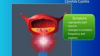 Candiduria Risk Factors Symptoms and Treatment [upl. by Sisto]