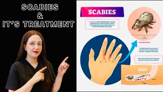 Scabies amp It’s Treatment  Dr Hira Khan [upl. by Ociram]