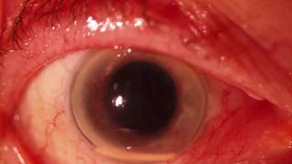 Endophthalmitis after Ozurdex injection Or not [upl. by Aynom]