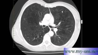 Emphysema on CT scan of Chest [upl. by Nidorf823]