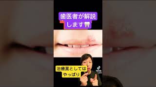 口内炎。何とかしたい🦷stomatitis 口内炎 応急処置 治療 早く治す 歯医者 薬 方法 歯科衛生士 歯科助手 豆知識 生理食塩水 [upl. by Arotal]