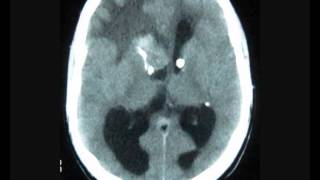 Frontal Intraventricular tumor with hydrocephalus [upl. by Marjana639]