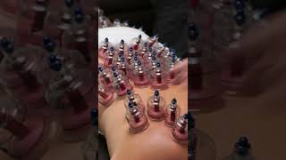 The Cupping Therapy an Ancient Treatment  InFact Tamil shortsvideo [upl. by Marylou]