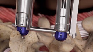 Threshold™ Pedicular Fixation System [upl. by Jillane567]